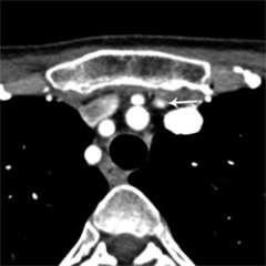 4D-CT Scan