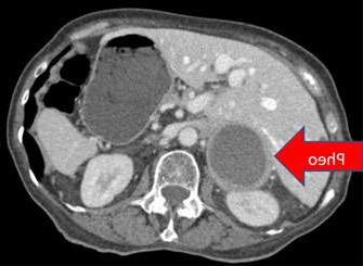 Von Hippel-Lindau Syndrome