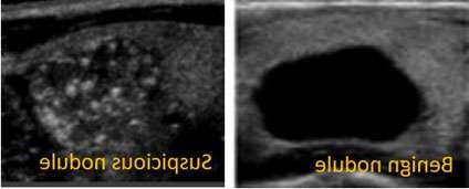 Thyroid Nodules