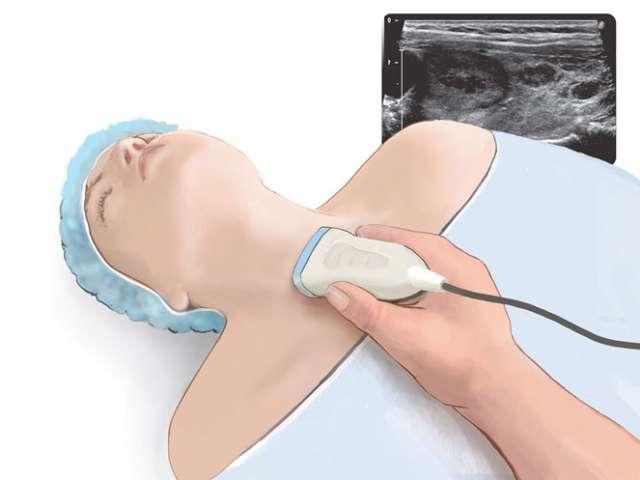 Thyroid Surgery Neck Ultrasound