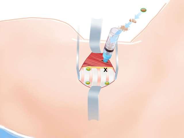 Thyroid Surgery Step 7 Inferior Pole