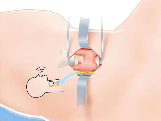 Thyroid Surgery Step 8 Identification/Preservation Laryngeal Nerve